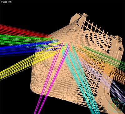 Stereotactic Radiosurgery with beams image